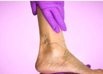 Šta su varikozne vene i koja je najmodernija metoda liječenja?