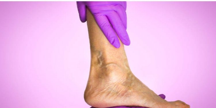 Šta su varikozne vene i koja je najmodernija metoda liječenja?