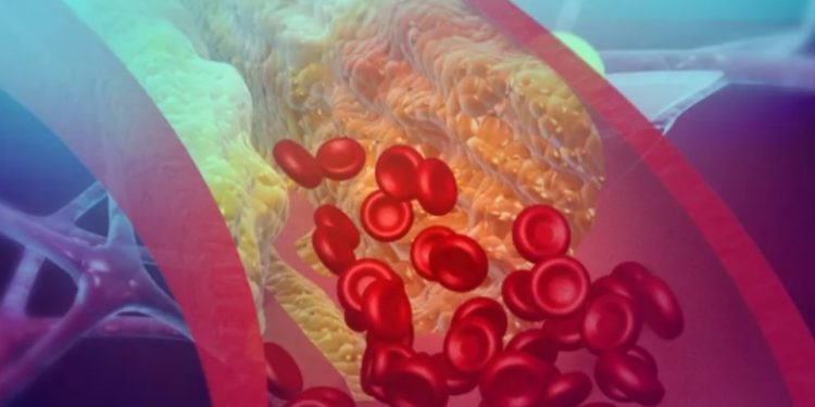 Revolucija u medicini: Injekcija čuva od srčanog i moždanog udara, daje se 2 puta godišnje